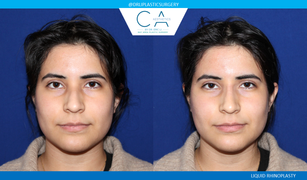 Fillers case #5041