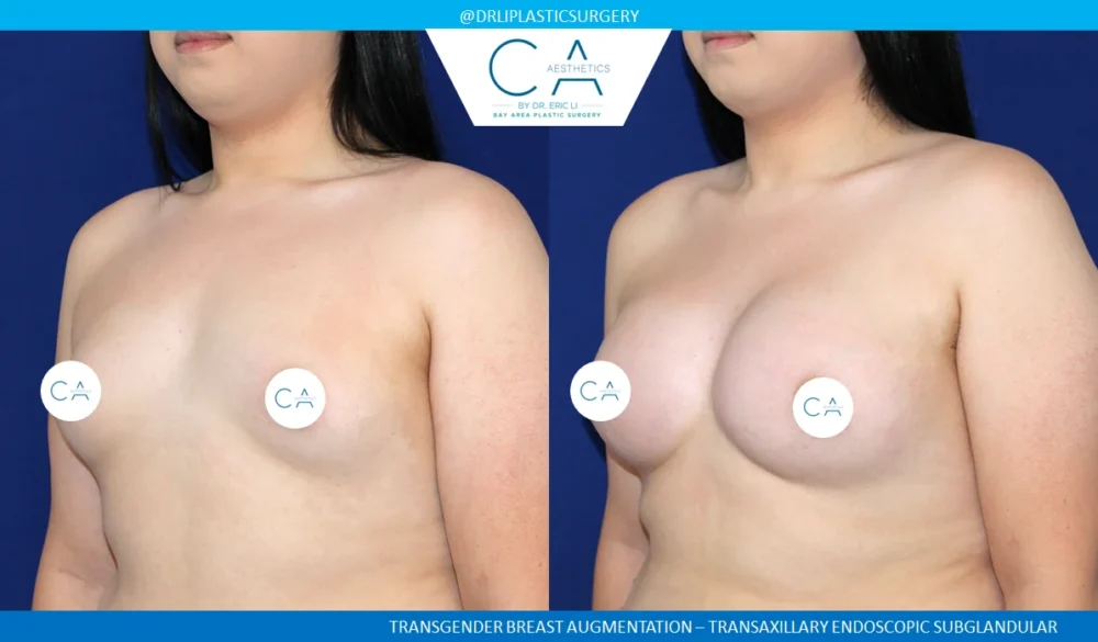 Breast Augmentation case #5203