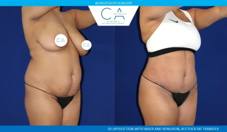 360 Liposuction (Torso) case #5492