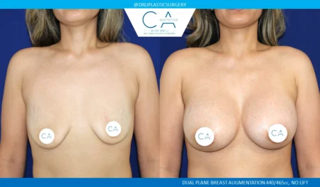 Breast Augmentation case #5202