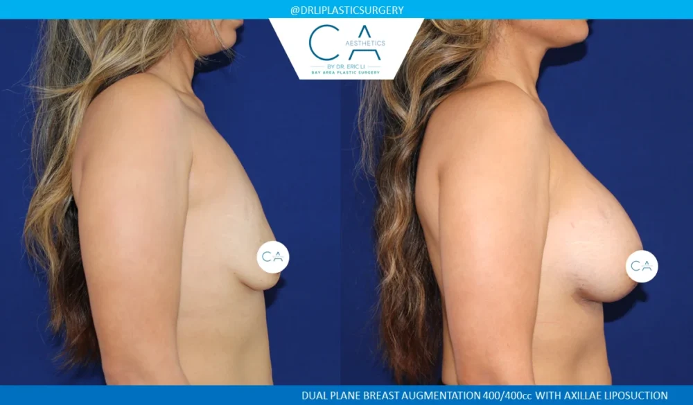 Breast Augmentation case #5202