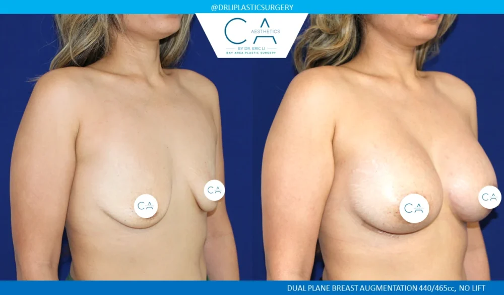 Breast Augmentation case #5202