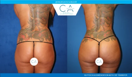 360 Liposuction (Torso) case #5491