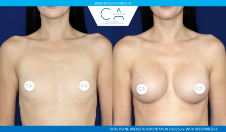 Breast Augmentation case #5201