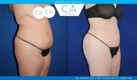 360 Liposuction (Torso) case #5490