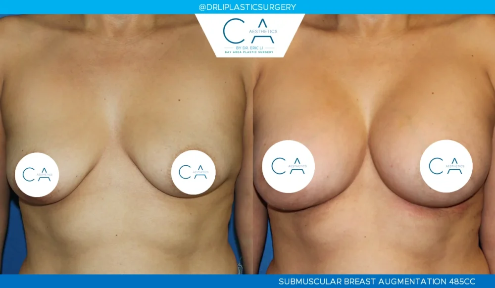 Breast Augmentation case #5200