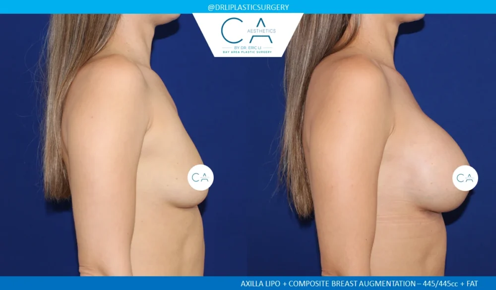 Breast Augmentation case #5101