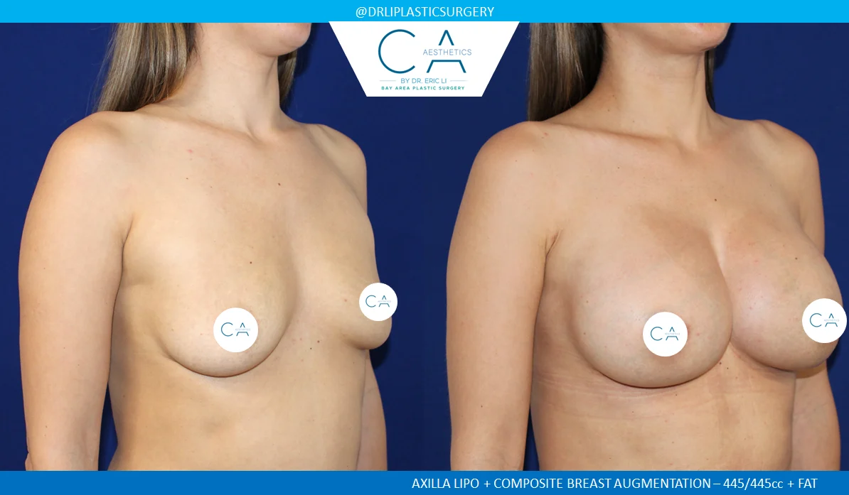 35 – Breast Augmentation Silicone Implants with Fat Oblique