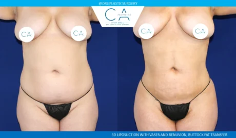 360 Liposuction (Torso) case #5487