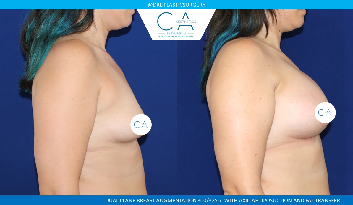 36 – Breast Augmentation with Fat Transfer and Axillae Liposuction Lateral