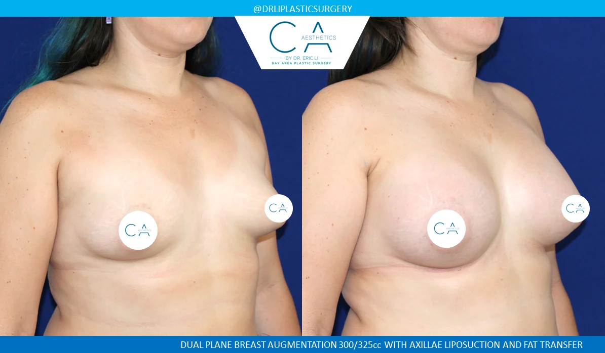 36 – Breast Augmentation with Fat Transfer and Axillae Liposuction Oblique
