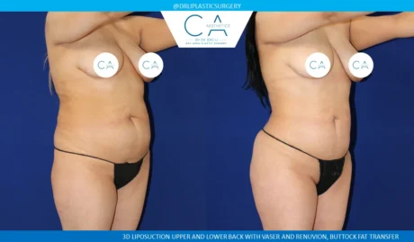 360 Liposuction (Torso) case #5486