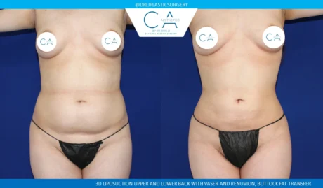 360 Liposuction (Torso) case #5485