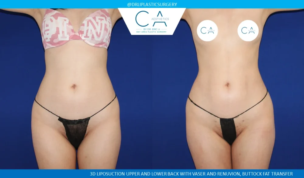 360 Liposuction (Torso) case #5484