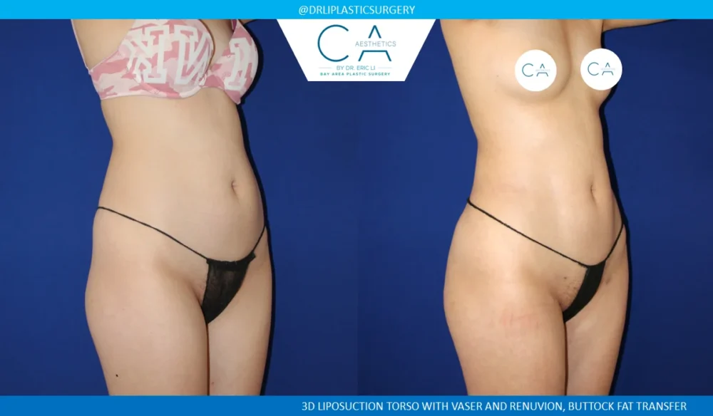 360 Liposuction (Torso) case #5484