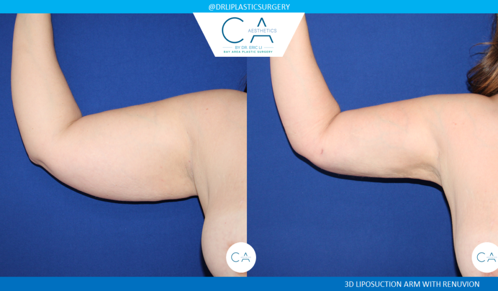 Arm Liposuction case #4563