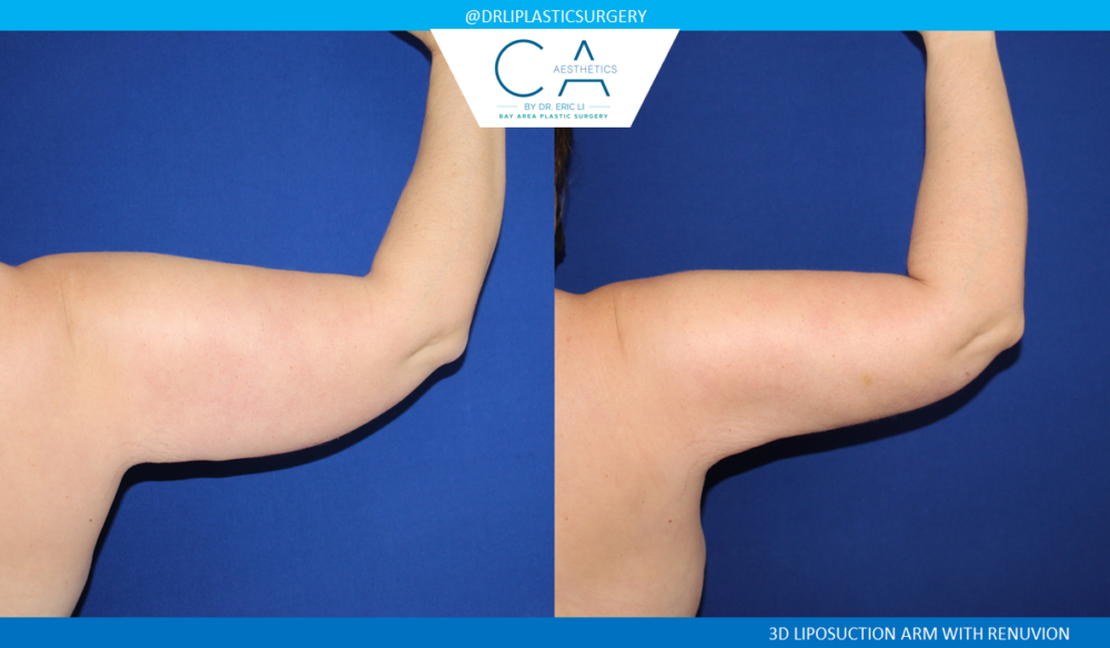 Arm Liposuction case #4563