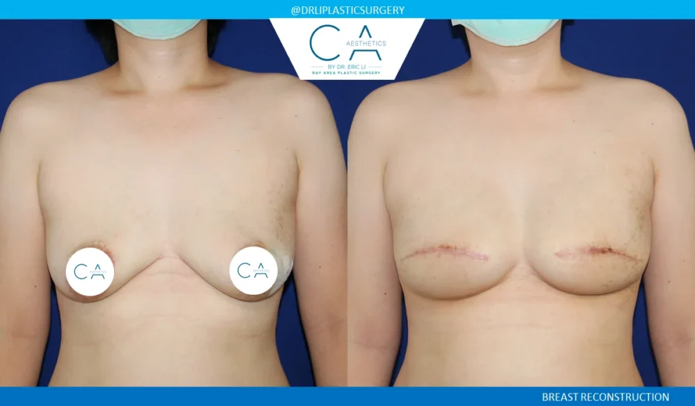 Breast Reconstruction case #5356