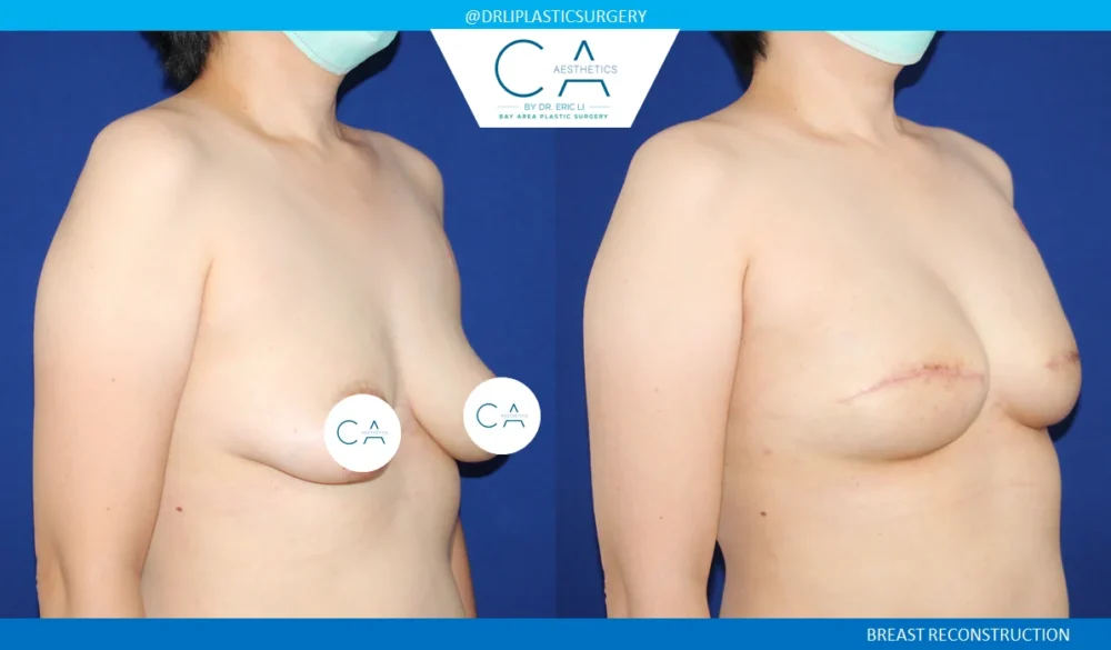 Breast Reconstruction case #5356