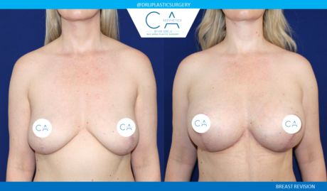 Breast Revision case #5271