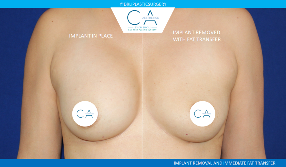 Breast Implant Removal case #4923