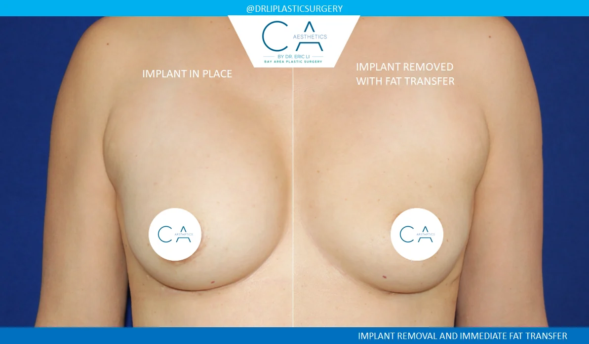 4 – Implant Removal and Fat Transfer