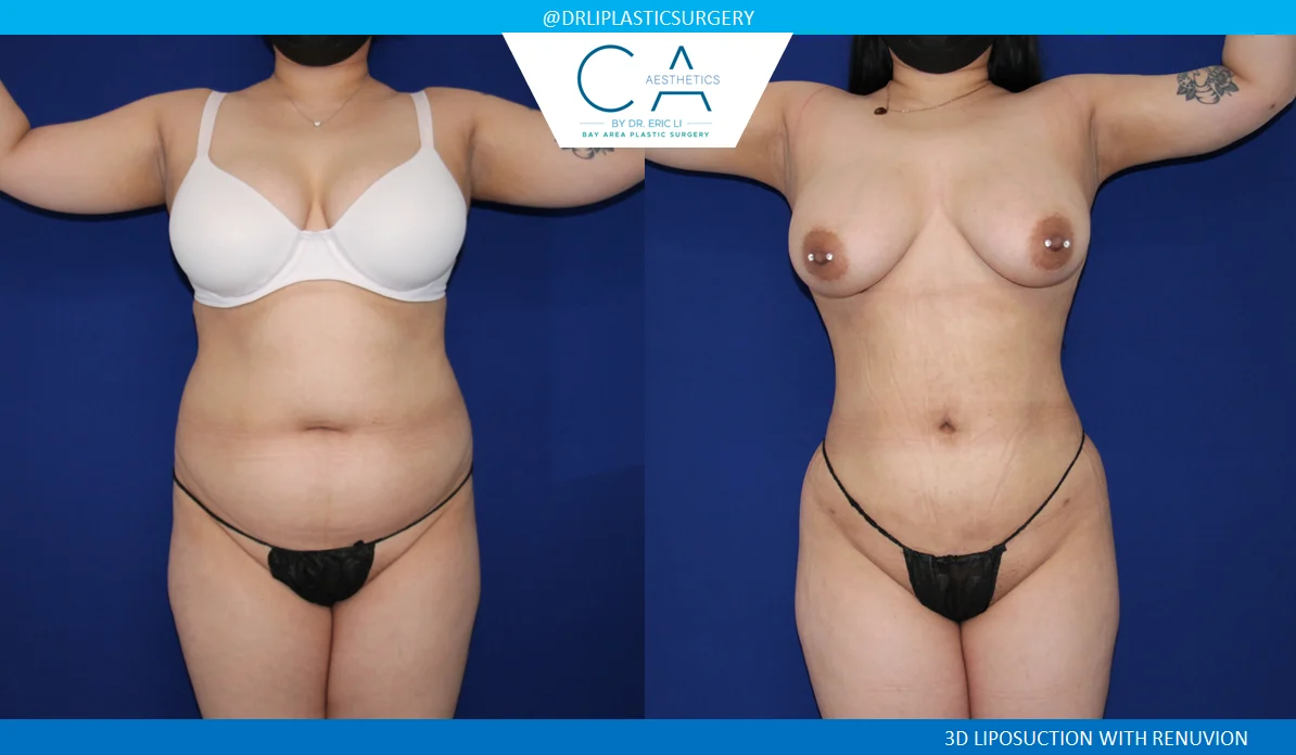 4 – Liposuction Abdomen and Back with Renuvion AP