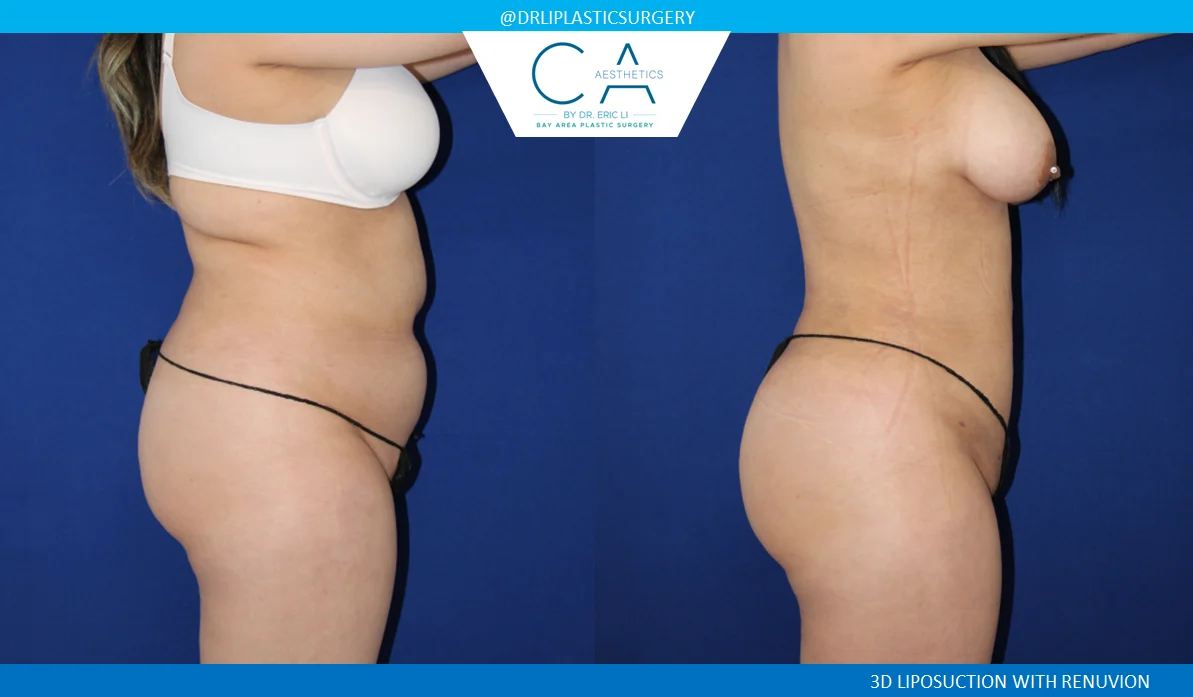 4 – Liposuction Abdomen and Back with Renuvion Lateral