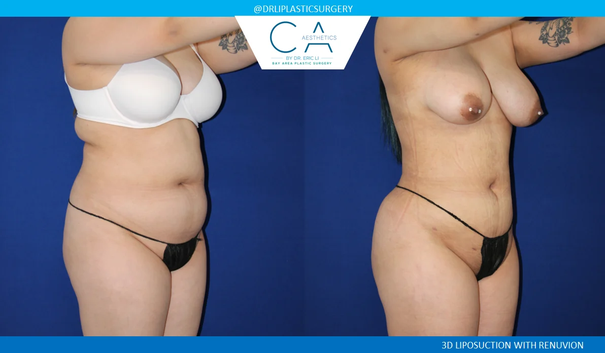 4 – Liposuction Abdomen and Back with Renuvion Oblique