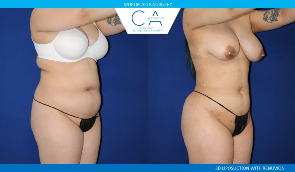 360 Liposuction (Torso) case #5527