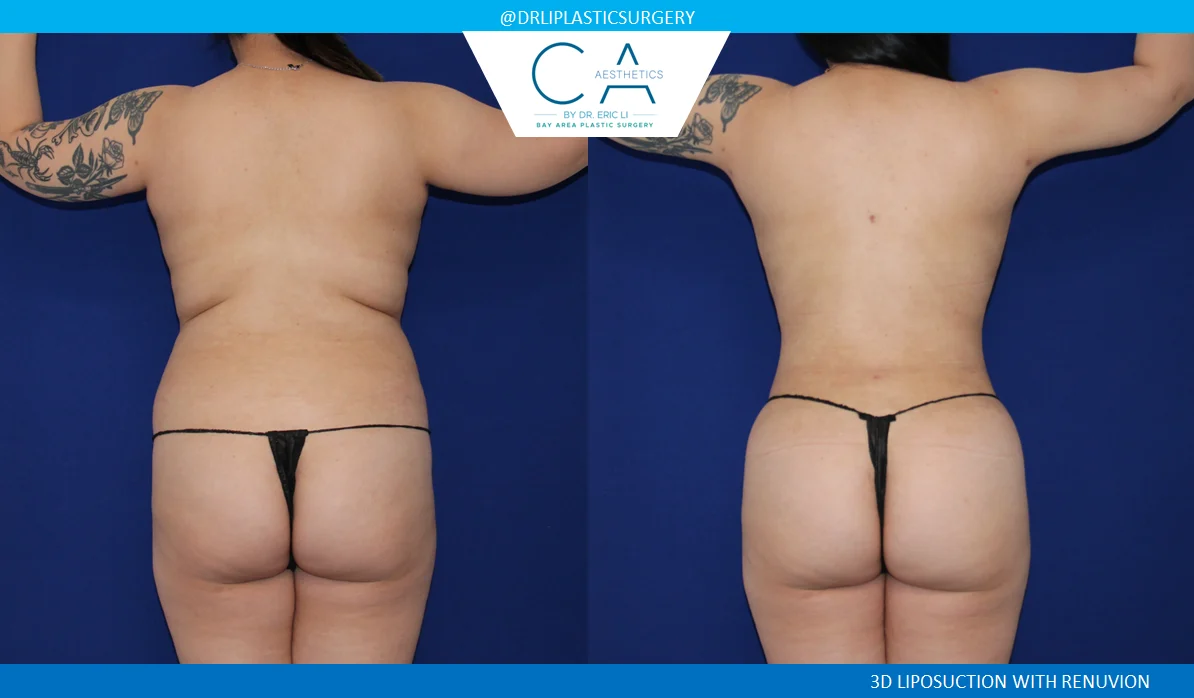 4 – Liposuction Abdomen and Back with Renuvion Posterior