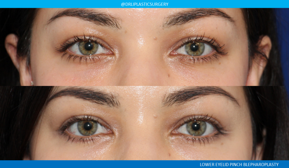 Lower Blepharoplasty (Eyelid Surgery) case #4727