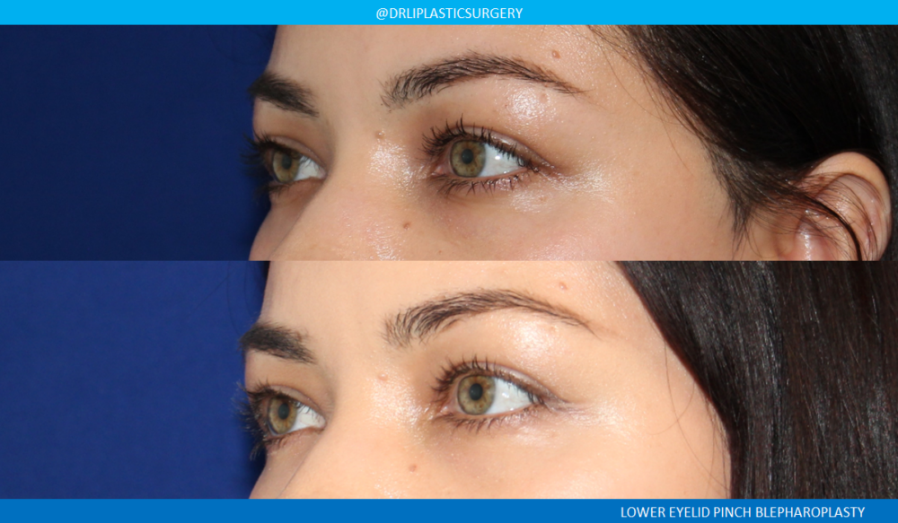 Lower Blepharoplasty (Eyelid Surgery) case #4727