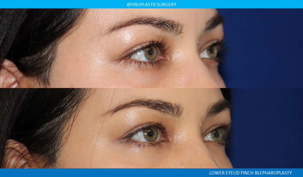 Lower Blepharoplasty (Eyelid Surgery) case #4727