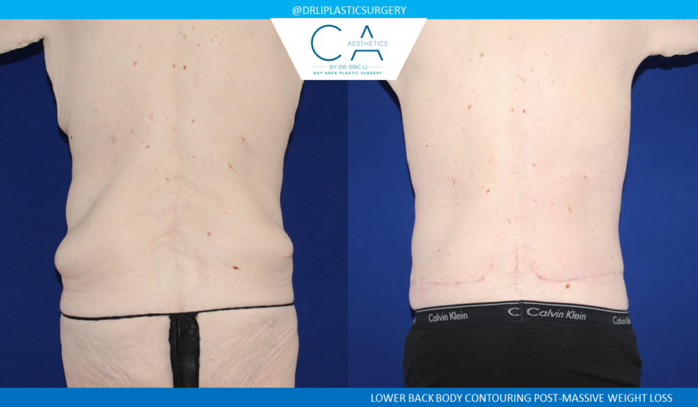 Male Liposuction case #4994