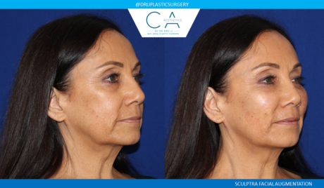 Fillers case #5067