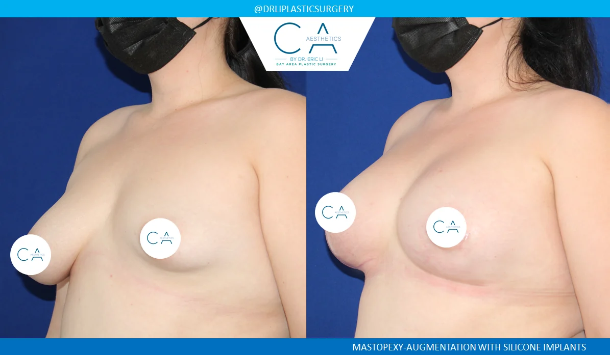 4 – Tuberous Breast Augmentation Silicone Implants with Lift Oblique 2