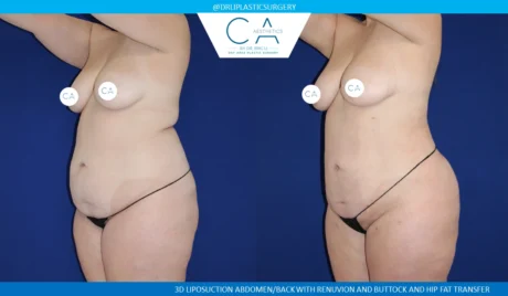 360 Liposuction (Torso) case #5369