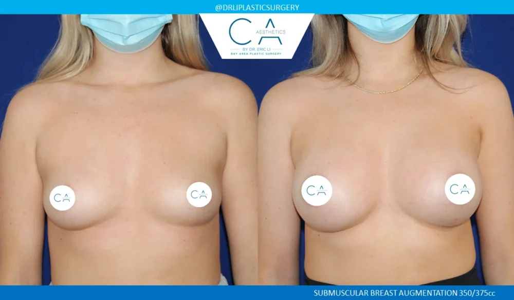 Breast Augmentation case #5229