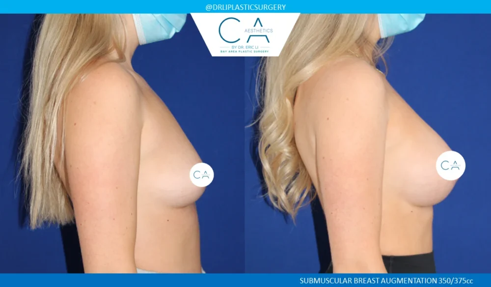 Breast Augmentation case #5229