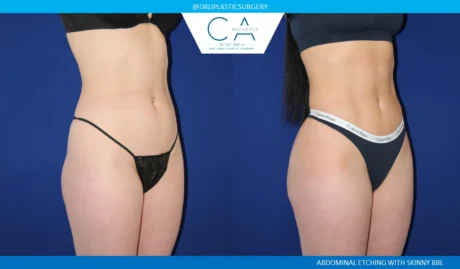 360 Liposuction (Torso) case #5526