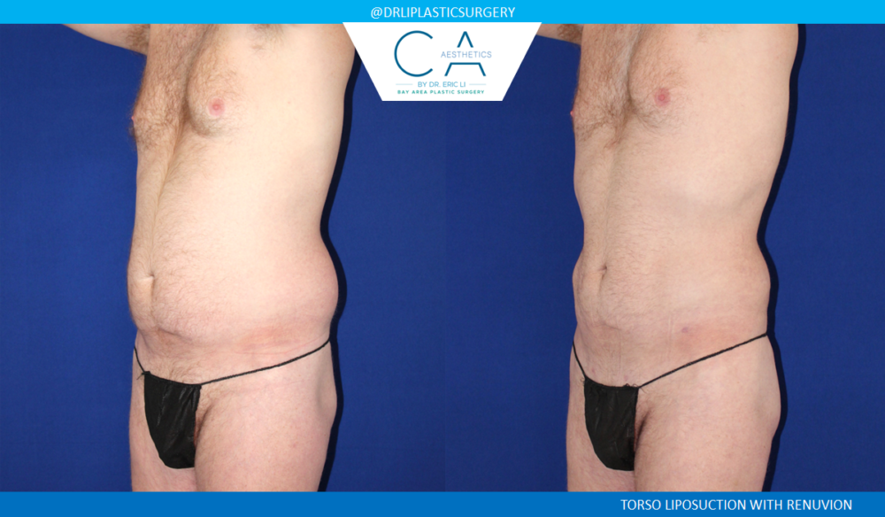 Male Liposuction case #4993