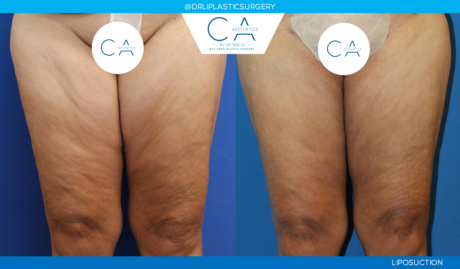 Leg Liposuction case #4973