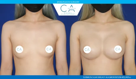 Breast Augmentation case #5228