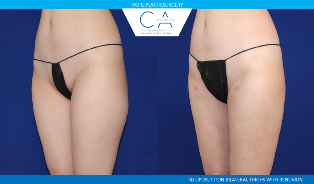 Leg Liposuction case #4972