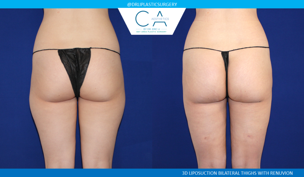 Leg Liposuction case #4972