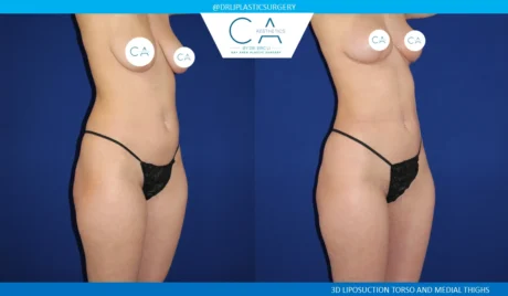 360 Liposuction (Torso) case #5525