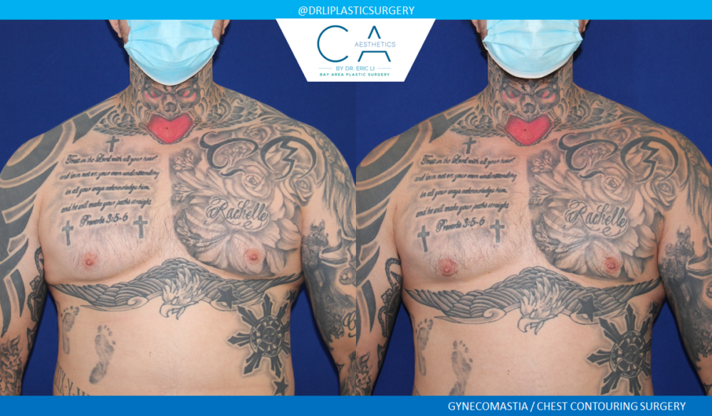 Male Liposuction case #4978