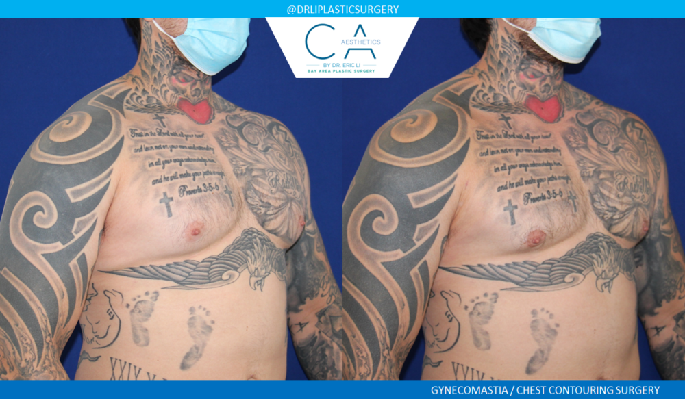 Male Liposuction case #4978