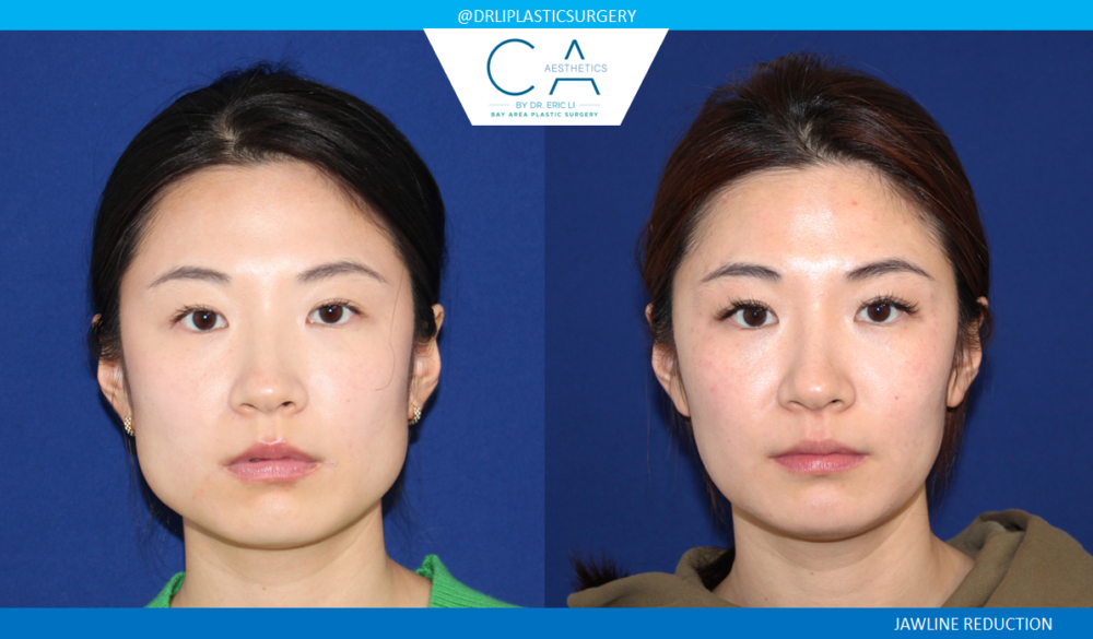 Asian Jawline Reduction case #4574